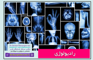 رادیولوژی,رادیولوژیست,مرکز رادیولوژی,مرکزتصویربرداری پزشکی,سونوگرافی,سونوگرافی واژینال,ماموگرافی,ماموگرافی سینه, رادیولوژی سینه,رادیوگرافی chest,گرافی دندان,گرافی بایت وینگ,رادیوگرافی دندان,OPG,گرافی اوپی جی,رادیوگرافیopg,سونوی واژینال,واژینال سونوگرافی,سونوگرافی خوب در اصفهان,سونوگرافی برست,مرکز تصویربرداری عالی در اصفهان,رادیوگرافی دیجیتال,رادیولوژی دیجیتال در اصفهان,سونوگرافی غربالگری,سونوگرافی ان تی,سونوگرافی NT, سونوی آنومالی,سونوی سه بعدی,سونوی4D,سونوی کالرداپلر رنگی,سونوی واژینال سه بعدی,سونوی واژینال رنگی,سونوهیستروگرافی,کالرداپلر اندام تحتانی,سونوی DVT, سونوی کاروتید,ماموگرافی دیجیتال,الاستوگرافی پستان,نمونه برداری پستان,نمونه برداری برست,رادیولوژی ساده و رنگی,هیستروسالپنگوگرافی,HSG,رادیوگرافی دیجیتال دندان,پانورکس,OPG,بایت وینگ,بیمارستان دکتر شریعتی اصفهان,بیمارستان شریعتی اصفهان,مجتمع پزشکان نوید,دکتر ساناز شایگانفر,دکترشایگانفر رادیولوژی,متخصص رادیولوژی در اصفهان,عکس شکستگی پا,عکس رنگی شکستگی بینی,گرافی بینی,گرافی دندان,گرافی ساق,تصویربرداری پزشکی در اصفهان,ام ار ای,سی تی اسکن,MRI,CTSKAN,grafi,graphy,sonoبورد تخصصی رادیولوژی,بوردتخصصی سونوگرافی,دکترشایگانفر رادیولوژیست,دکترشایگانفر متخصص رادیولوژی در اصفهان,تصویربرداری دیجیتال پزشکی,دیجیتال پزشکی,متخصص تصویربرداری پزشکی